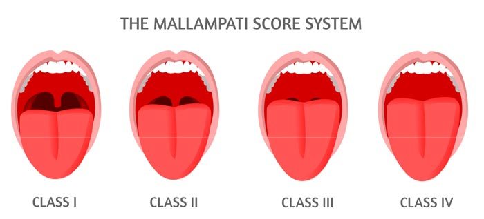 What Is The Mallampati Score Myofunctional Therapy Exercises For Mouth Breathing Sleep Apnea