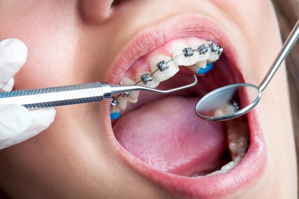 Orthodontic relapse