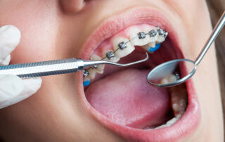 orthodontic expansion myofunctional-therapy