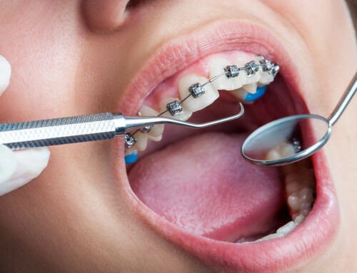 What Is Orthodontic Expansion?