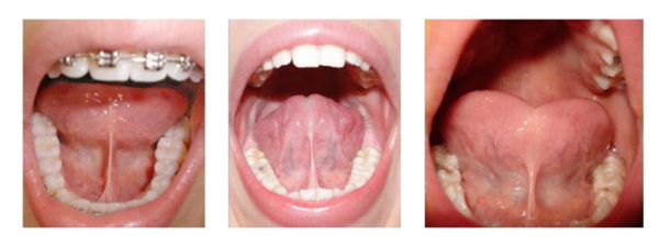 Anterior Tongue-Tie