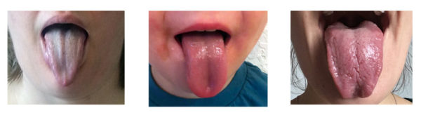 Posterior Tongue-Tie