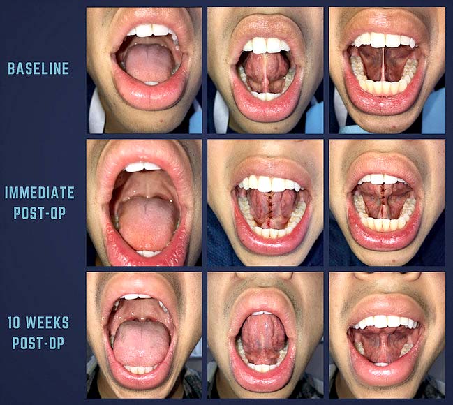 functional frenuloplasty