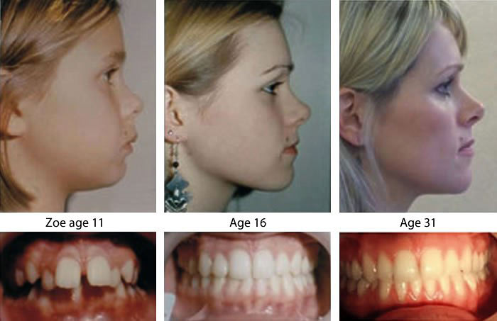 Orthodontic expansion and myofunctional therapy