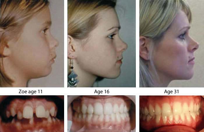 Palatal Expansion Isn't A New Idea - Faceology